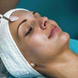 Melasma Chemical Peel