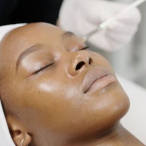 Dark Spot Chemical Peel