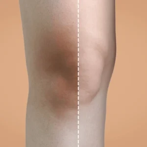 Whitening – Knees & Elbows